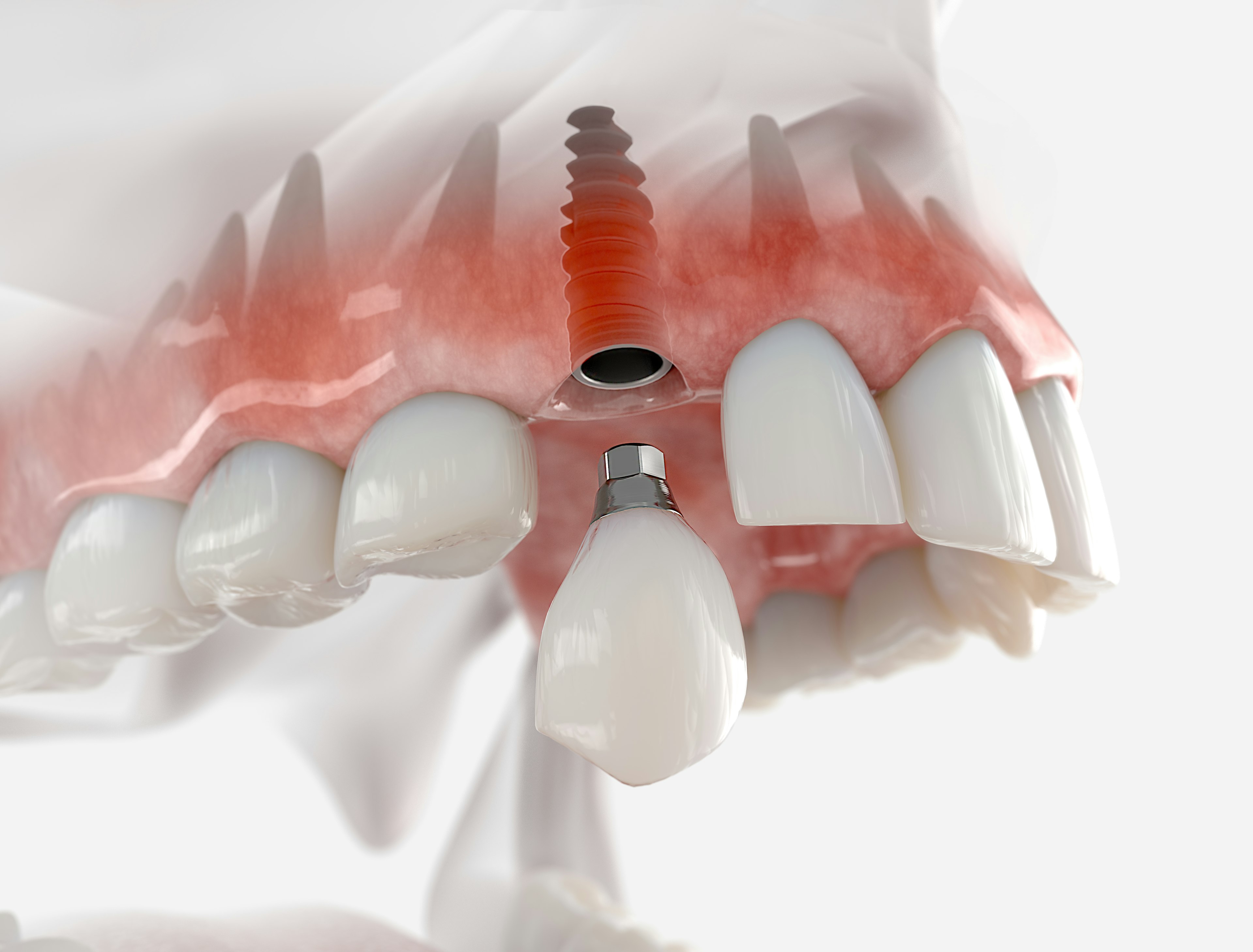 Dental Implant Vs Bridge