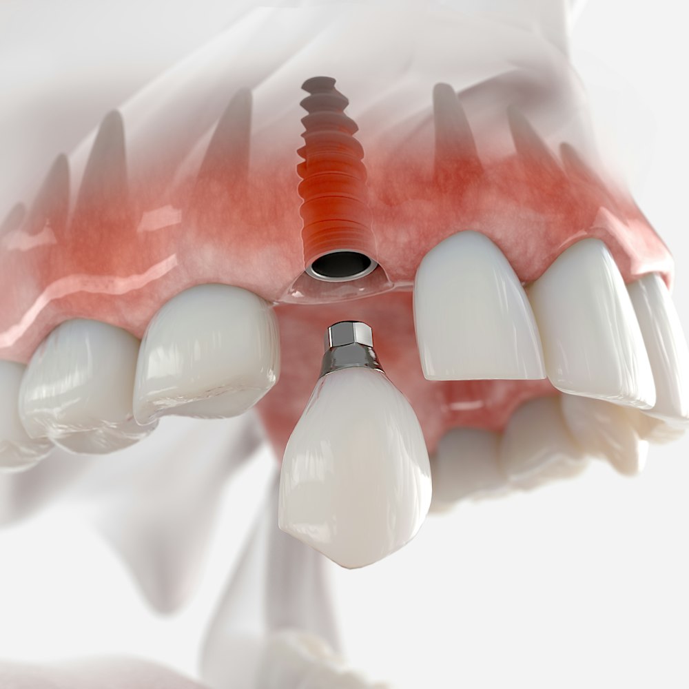 Dental implant