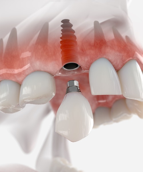 implant-supported crown