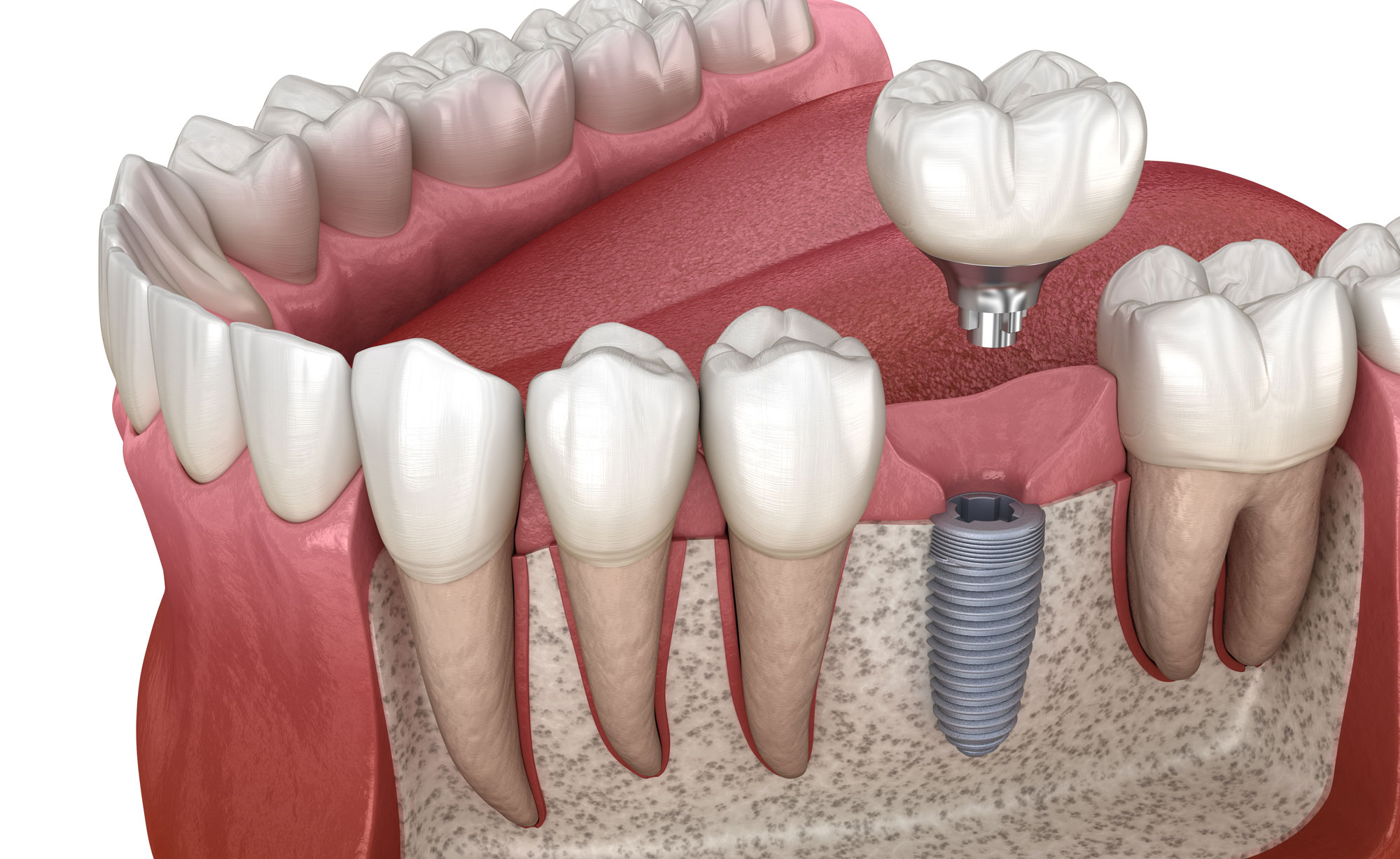 Dental implant