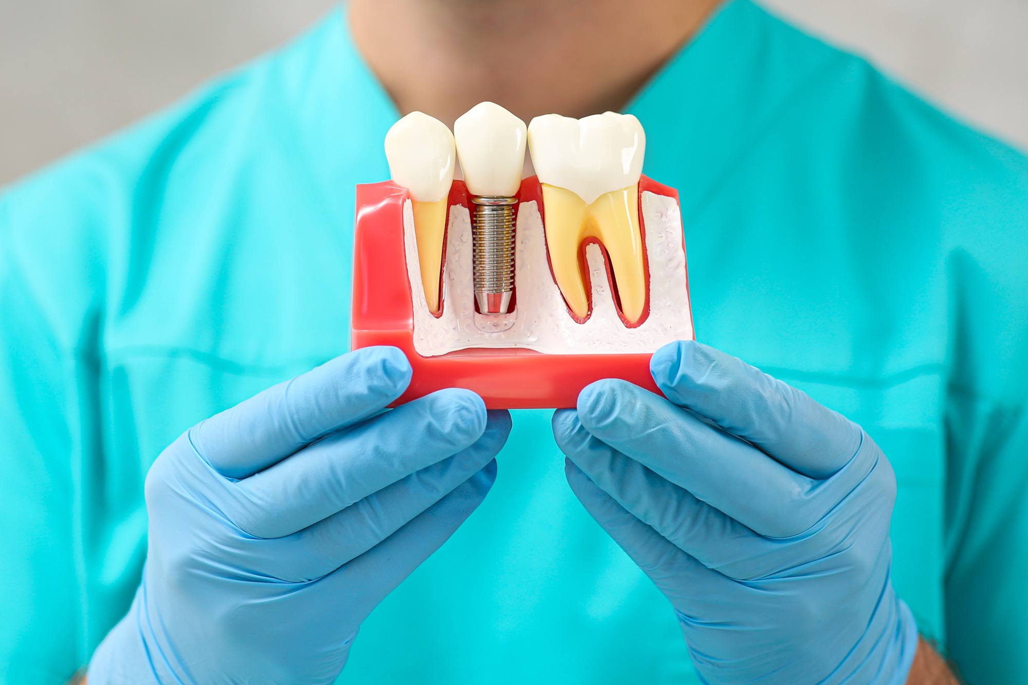 model of dental implants