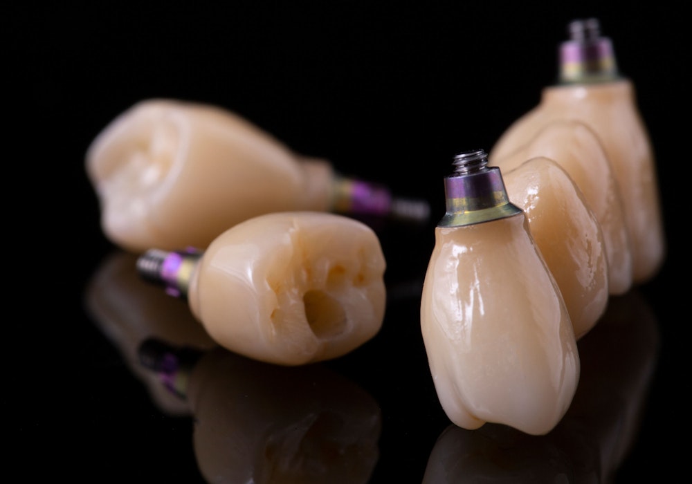 Dental implant-supported restorations