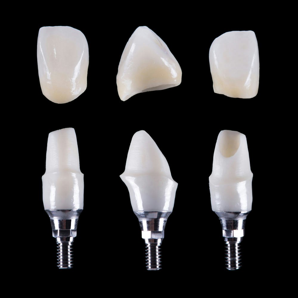 dental implants