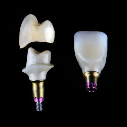 dental implants crowns