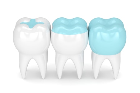 Inlays and Onlays Kansas City, MO - John P. Goodman DDS