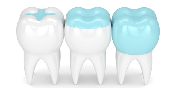 Dental inlay, onlay, and crown models