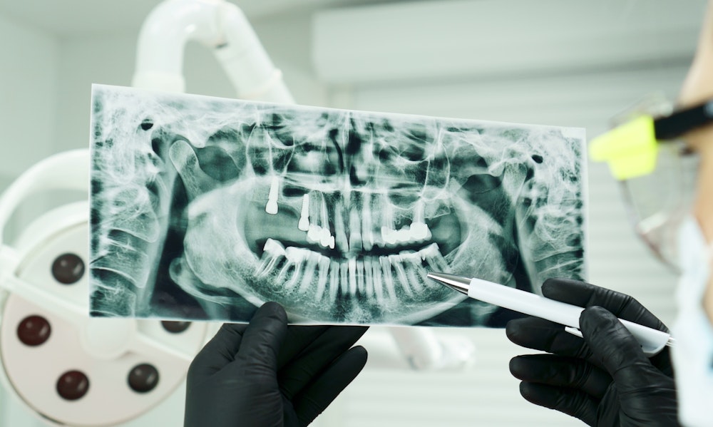 A dentist holding an x-ray of crowded teeth