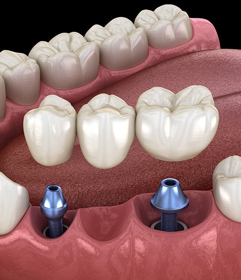 an implant bridge being placed