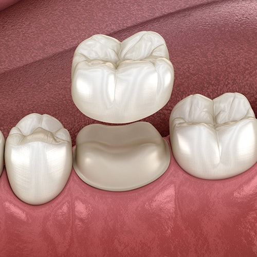 Dental crown