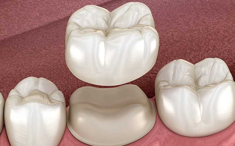 Dental crown