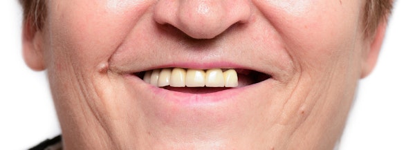 Man with missing teeth