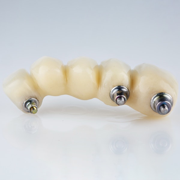 Dental bridge implant