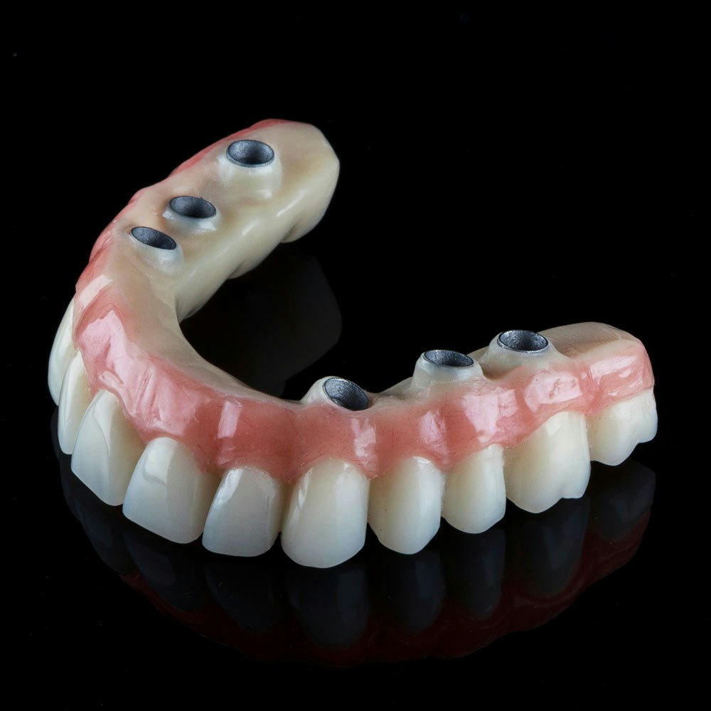 Overdenture
