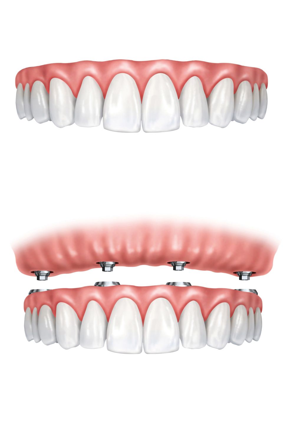 Traditional vs. implant denture