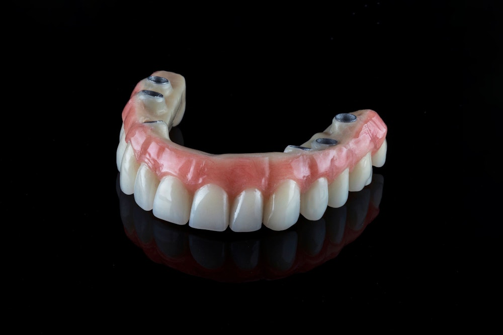 an implant-supported denture