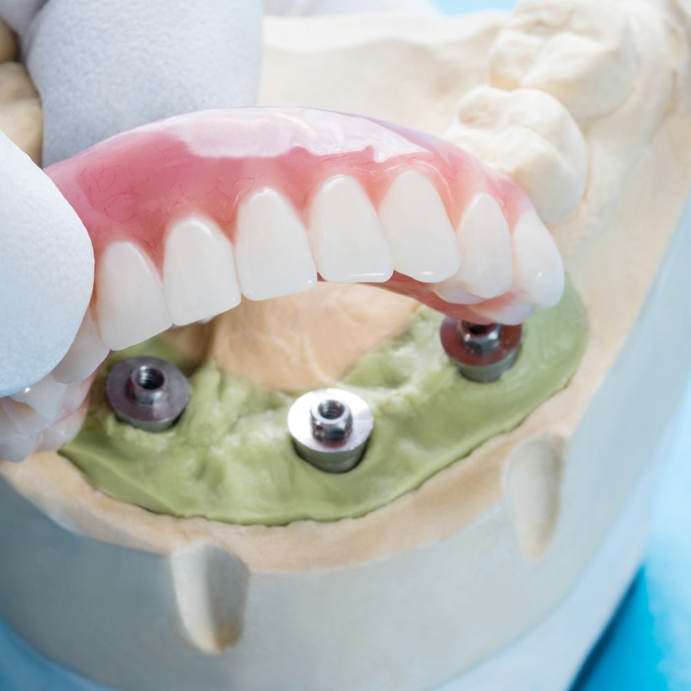 Model of an implant-supported denture