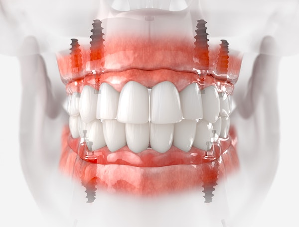Implant denture
