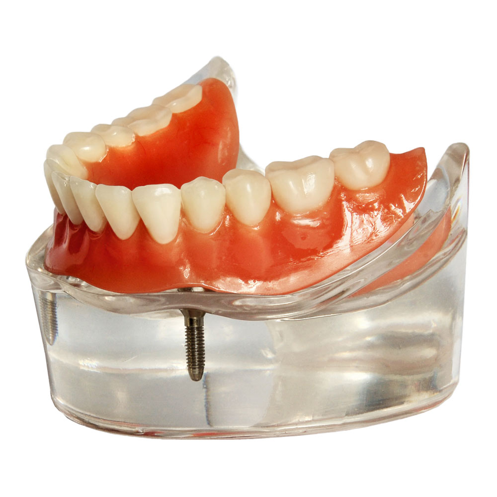 Implant denture