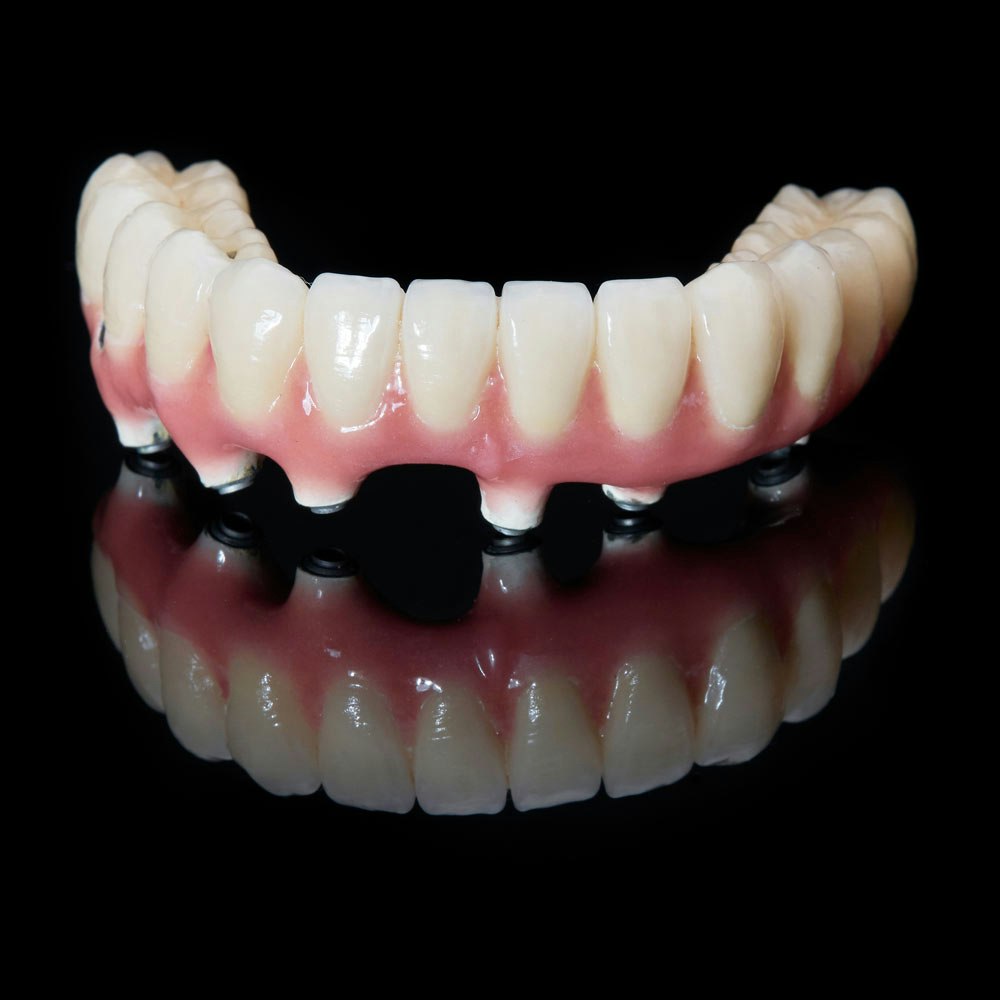 Denture implants