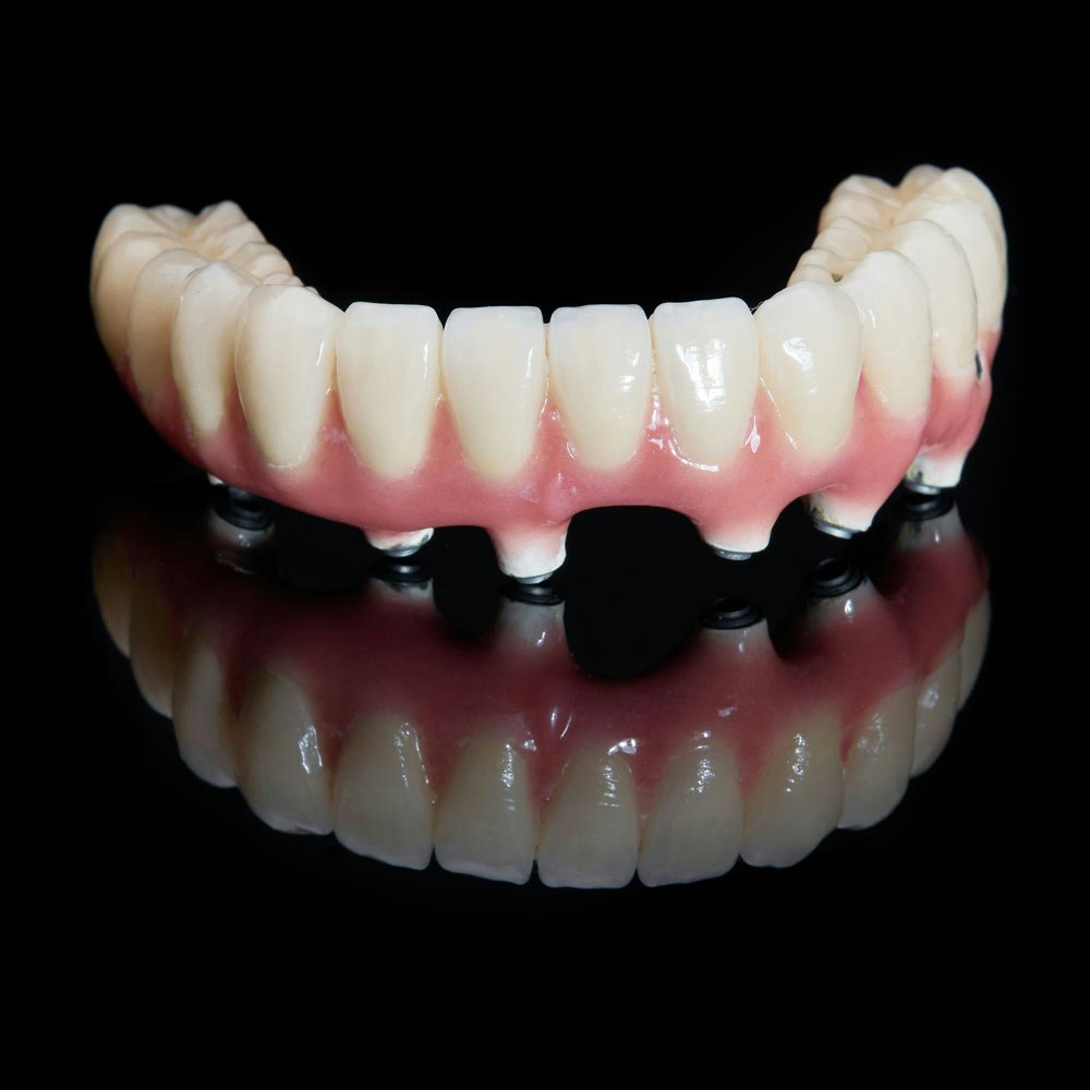 Implant-Supported Denture