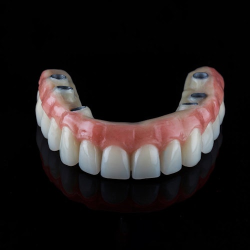 Denture implants