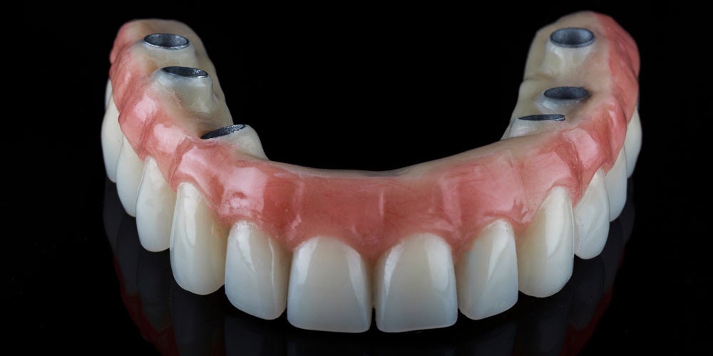 Denture implants