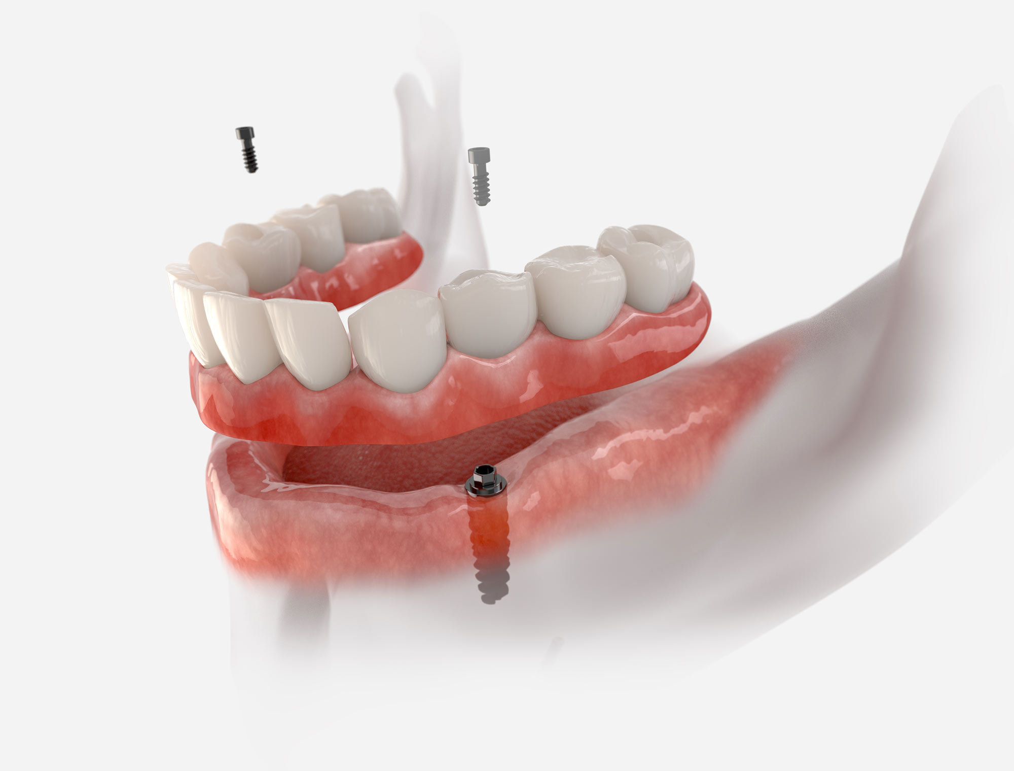 an implant-supported denture for the lower jaw