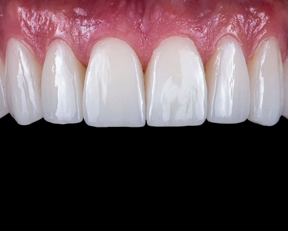 Veneer placement