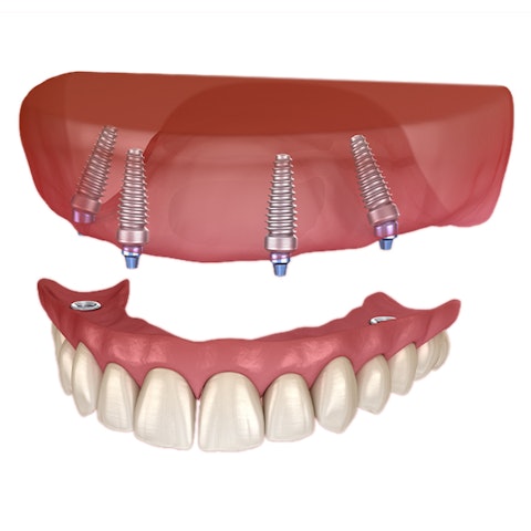 Implant-support denture illustration