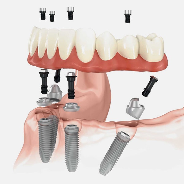 All-on-4® dental implants