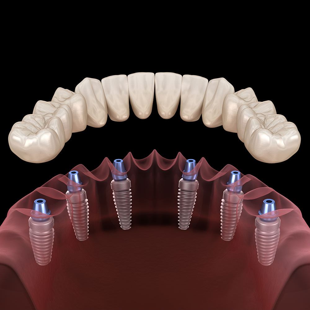 All-on-6 denture and implants