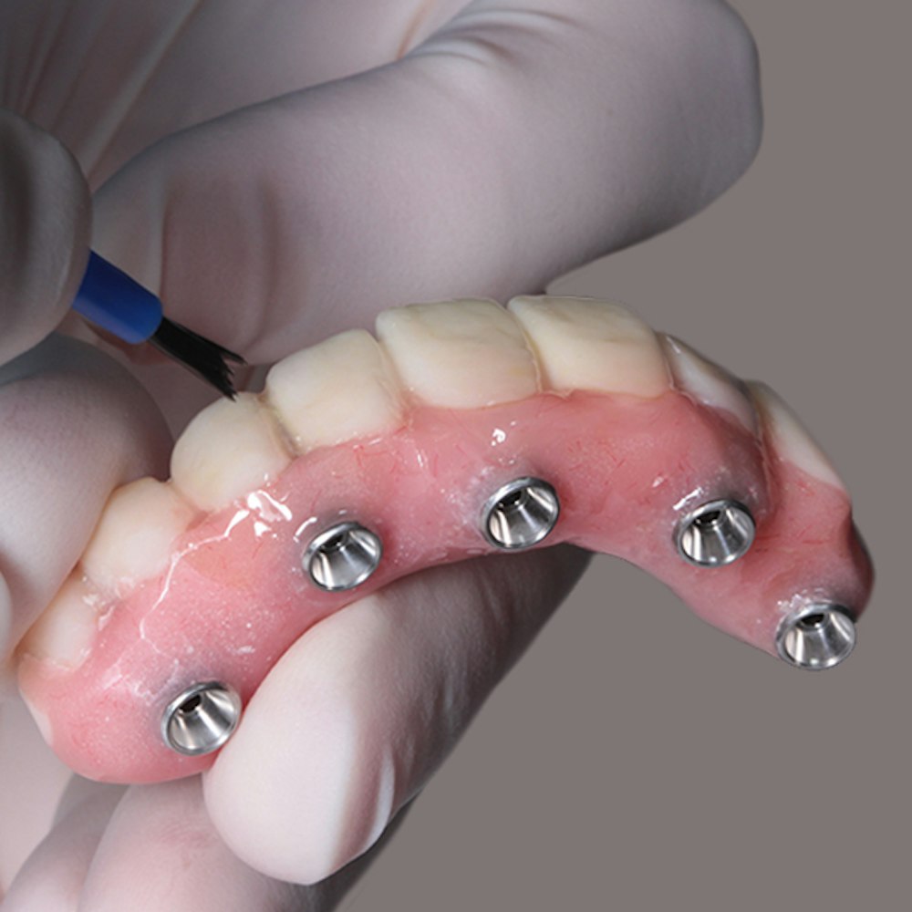 Implant Dentures