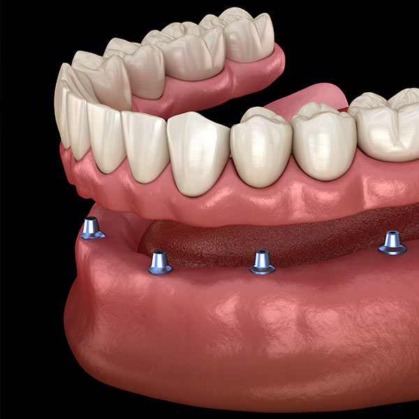 Implant-Supported Dentures