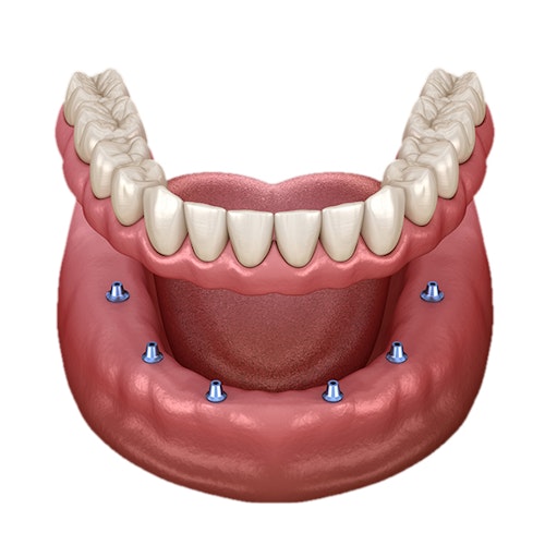 Traditional Dental Implants