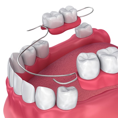 partial dentures