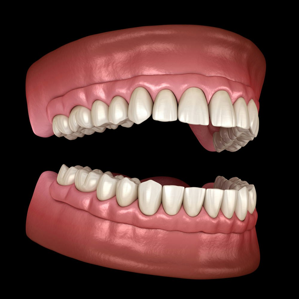 dentures