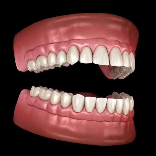Full dentures