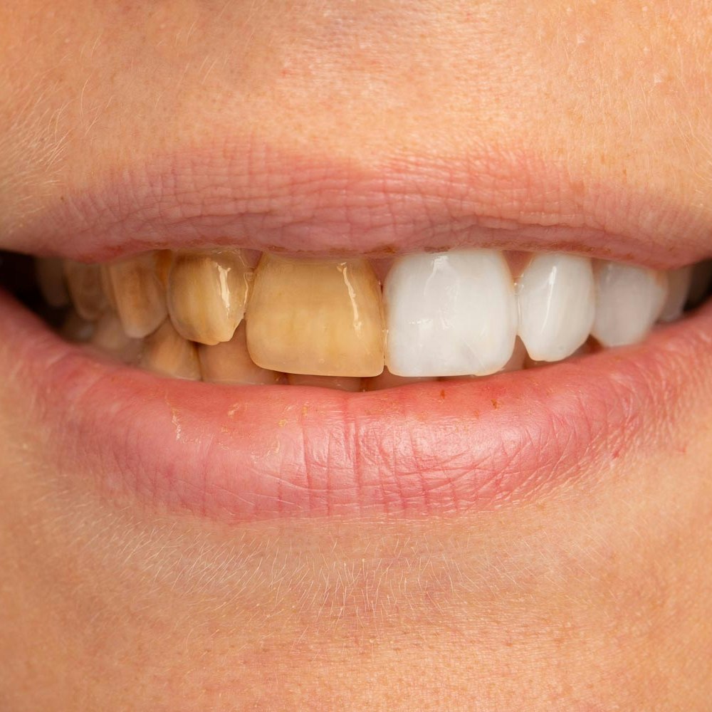 tooth with intrinsic stains