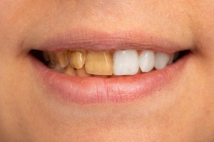 Stained teeth on the left and white teeth on the right