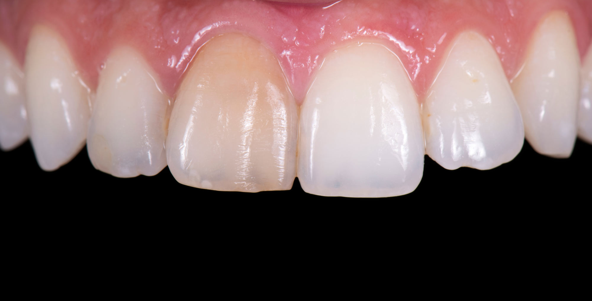 Discolored teeth up close