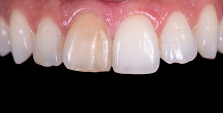Discolored teeth up close