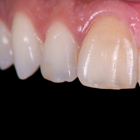 Discolored teeth up close