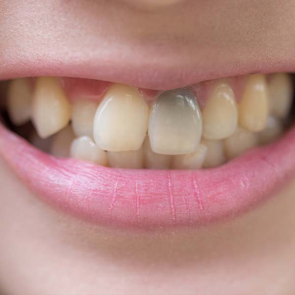 Discolored Tooth Filling, Annapolis Specialist for Restoring Your Dental  Aesthetics