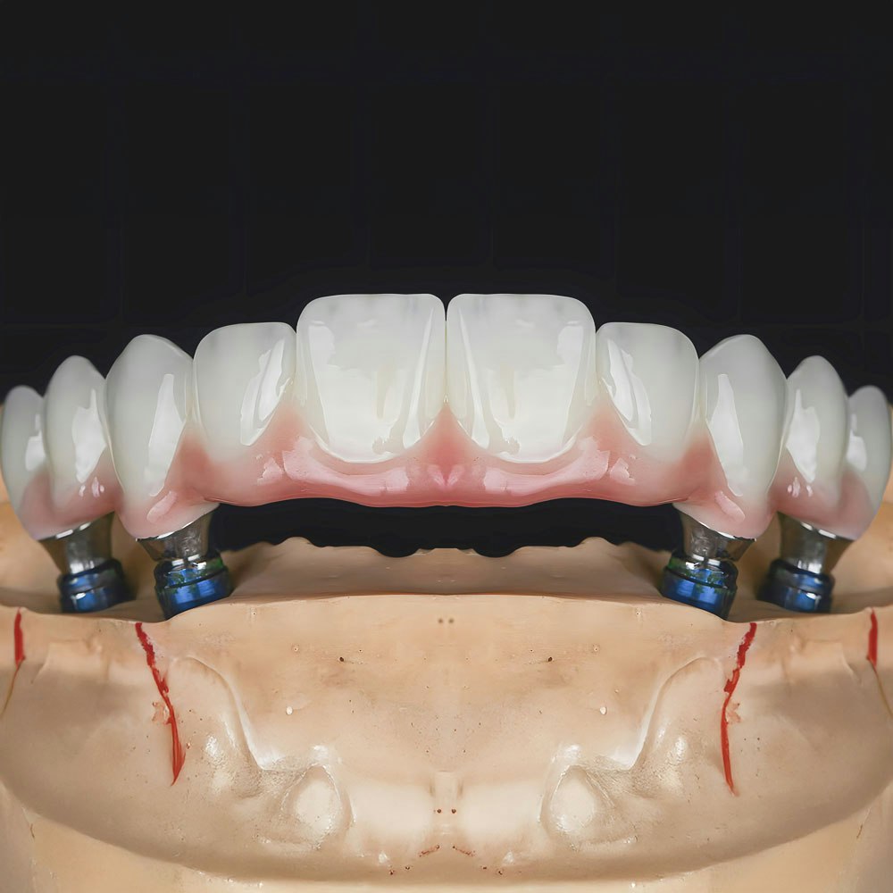 Model of implant denture