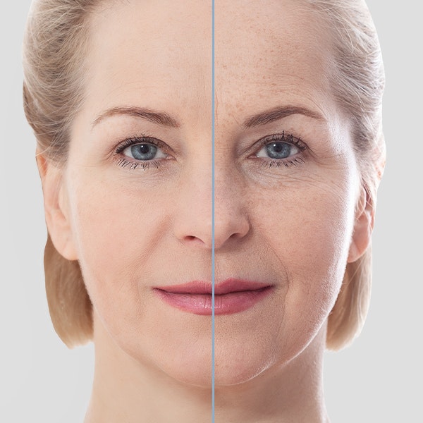 Smiling woman before and after a mini facelift