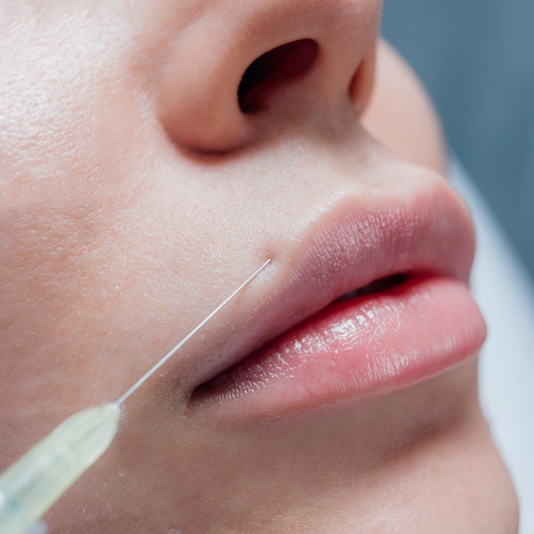 JUVÉDERM® patient with filler needle pointed at lips