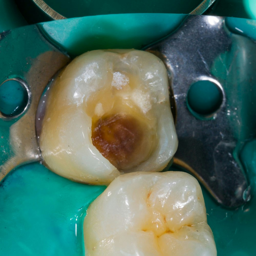 Before tooth filling