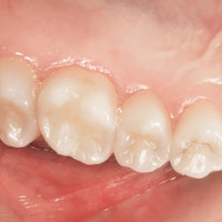 Dental filling