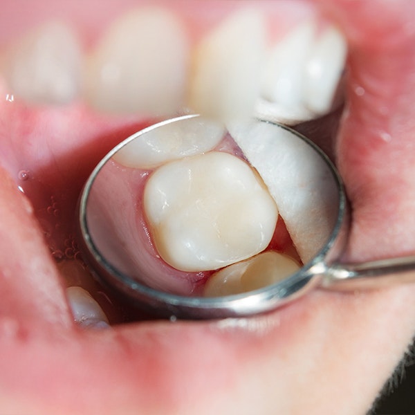 Dental filling