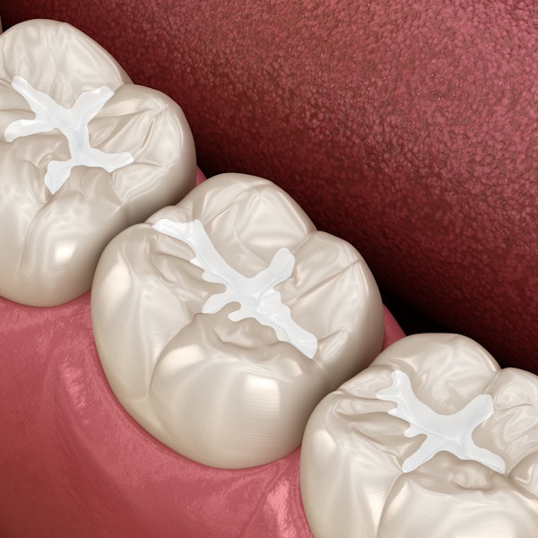 Tooth-colored fillings